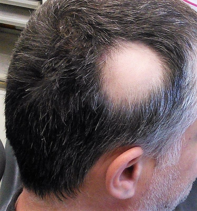 Classifications of Patterned Hair Loss