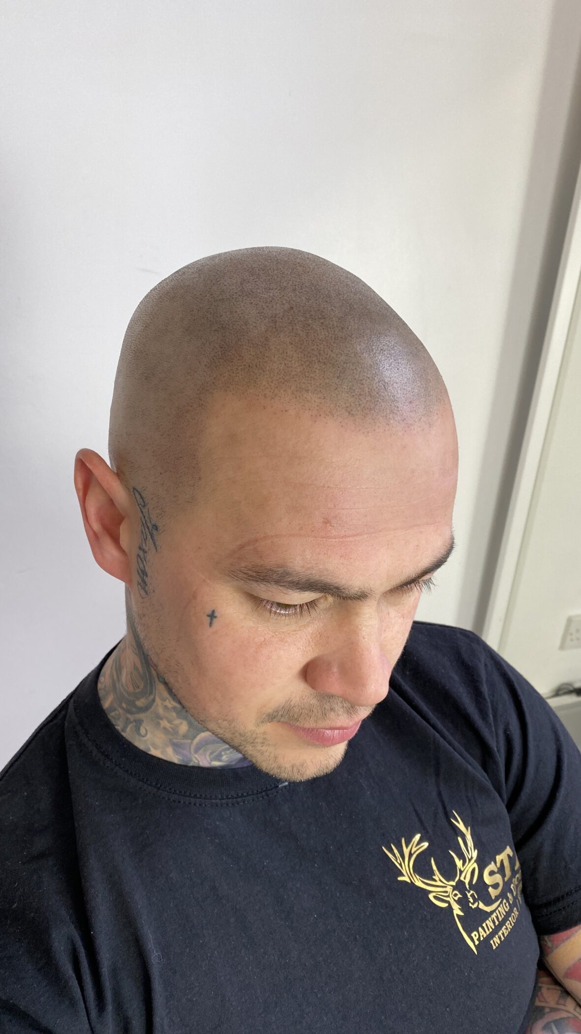 Scalp Micropigmentation Repair