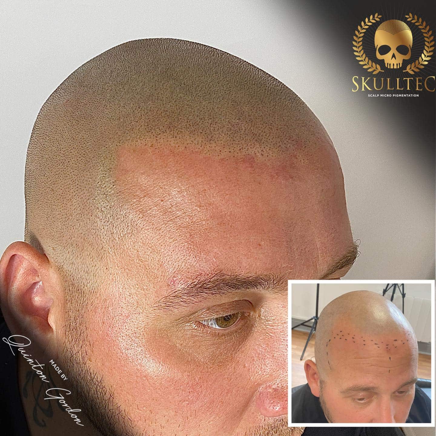 Scalp Micropigmentation Treatment Taunton