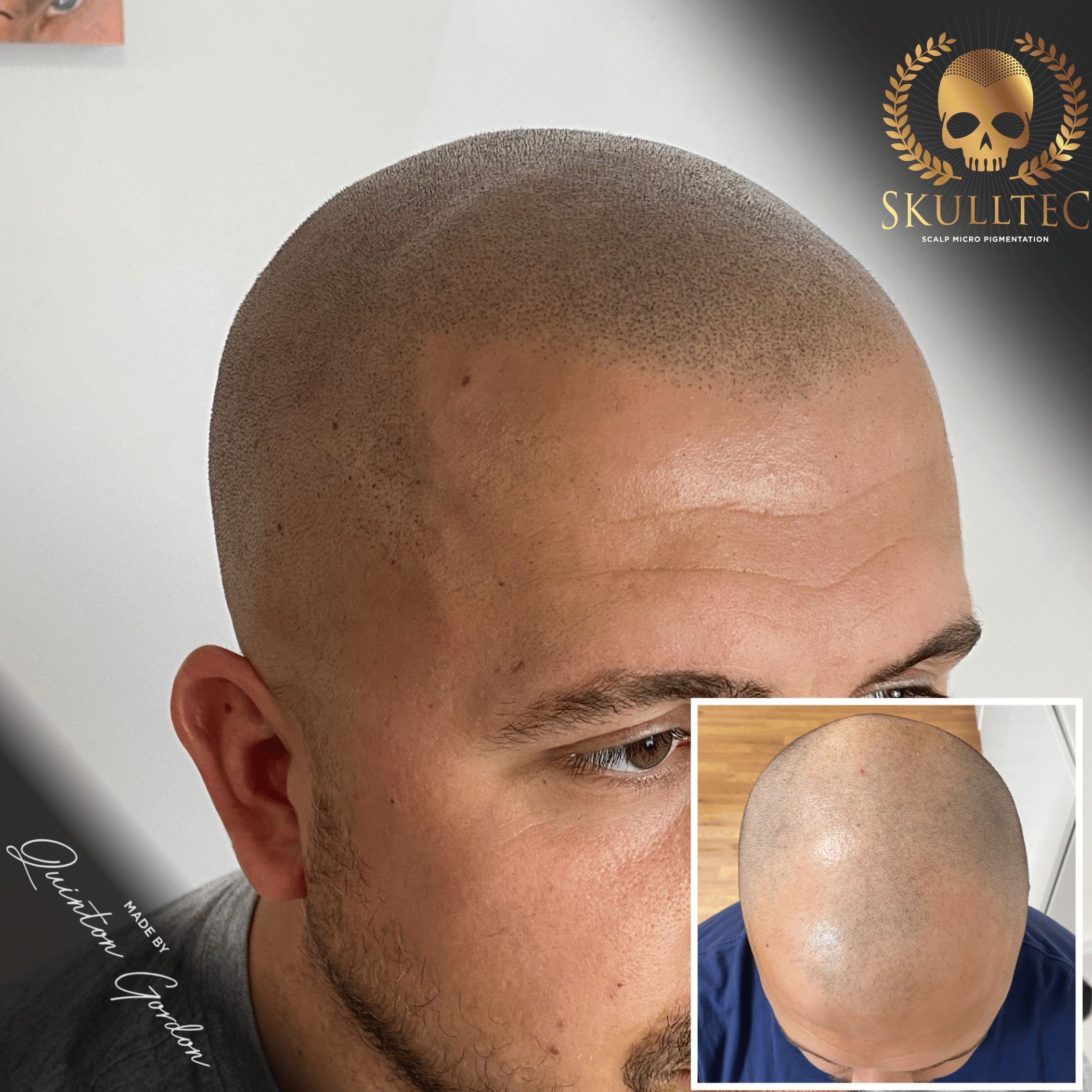 Scalp Micropigmentation Treatment Dorset