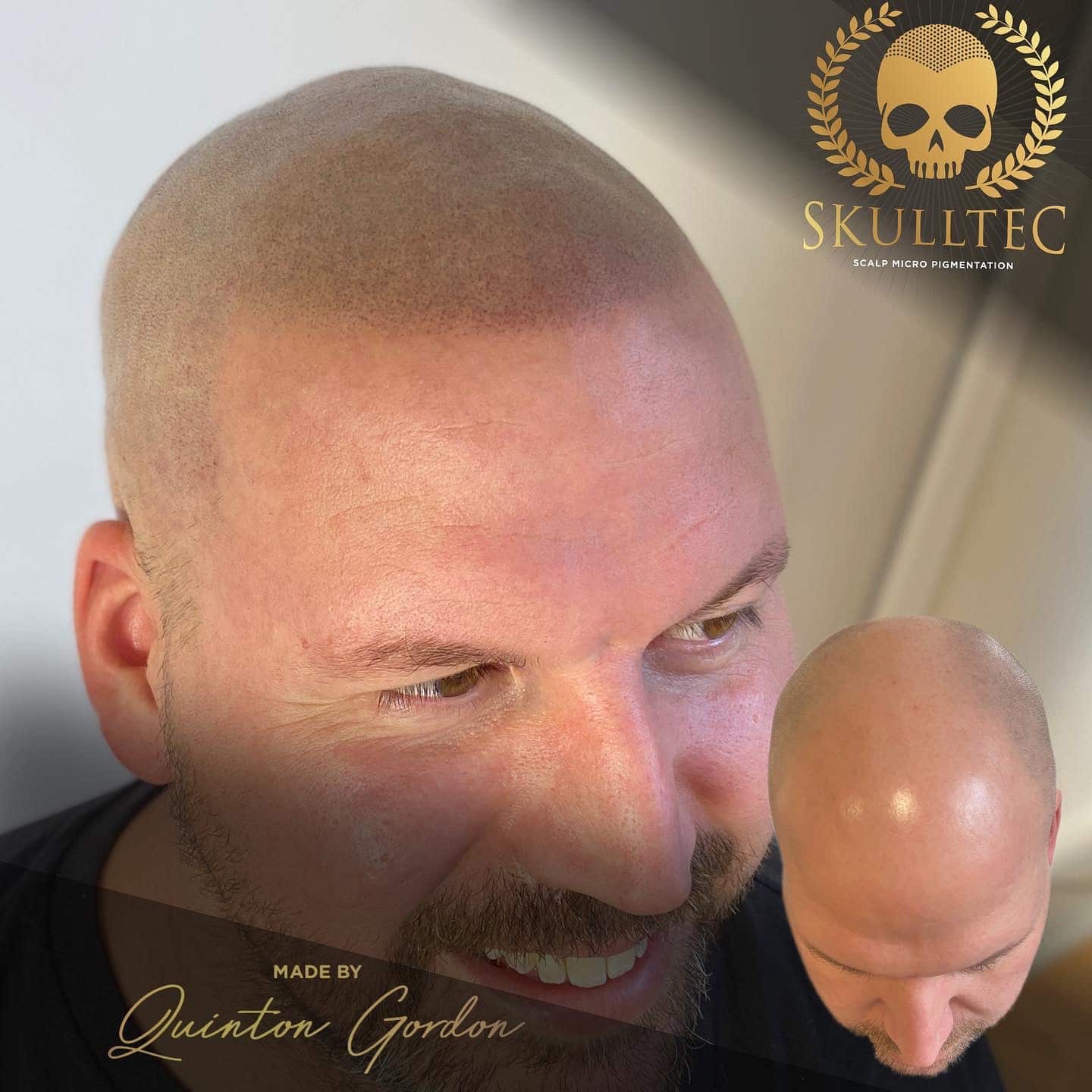 Scalp Micropigmentation Treatment Plymouth