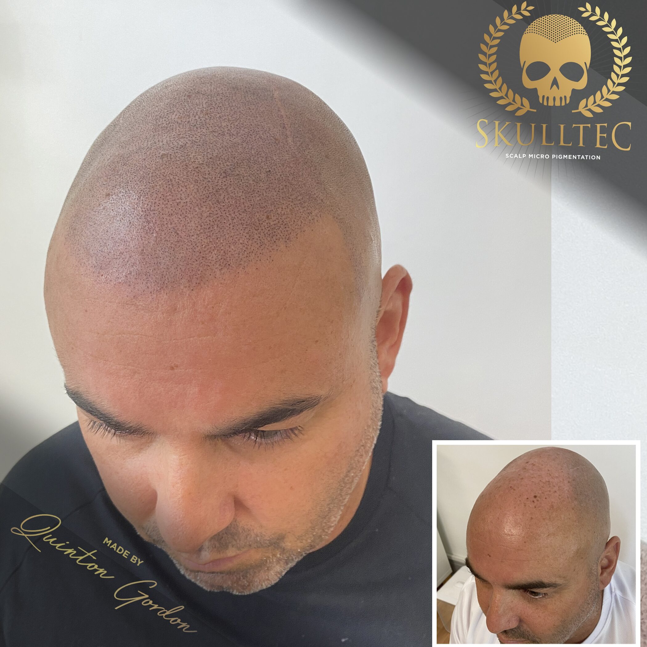 Scalp Micropigmentation Treatment Devon